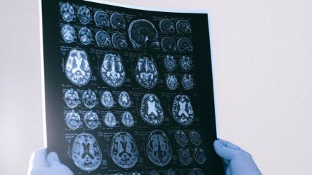 Nuevo servicio de neuropsicología en Ávila para daño cerebral y enfermedades neurodegenerativas